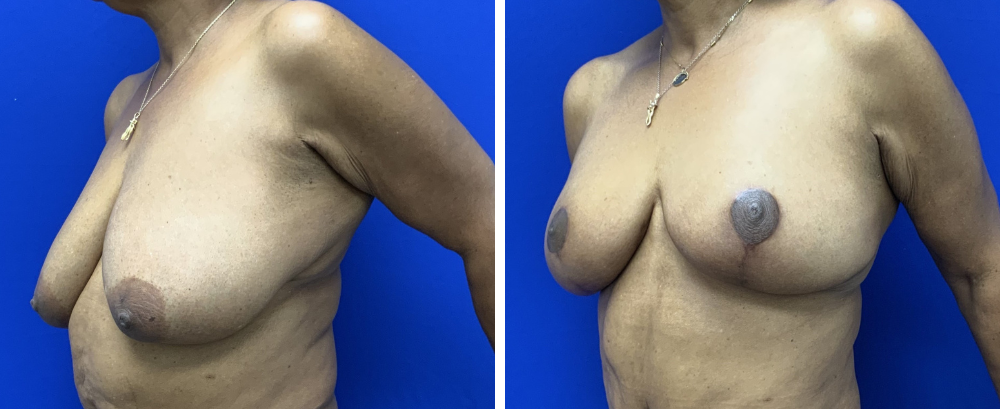 breast reduction case 22-3