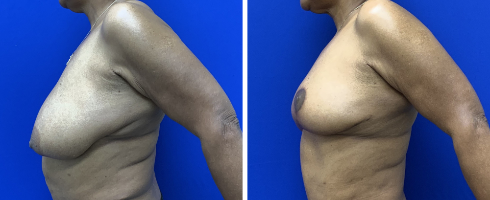 breast reduction case 22-4