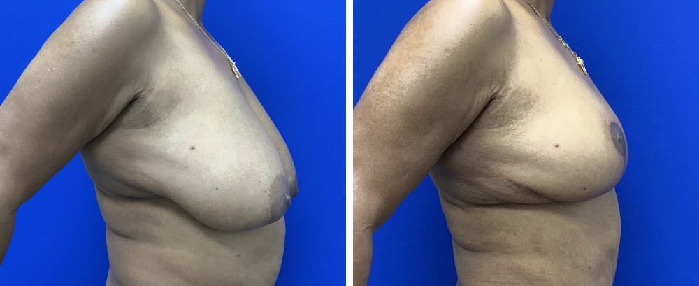 breast reduction case 22-5