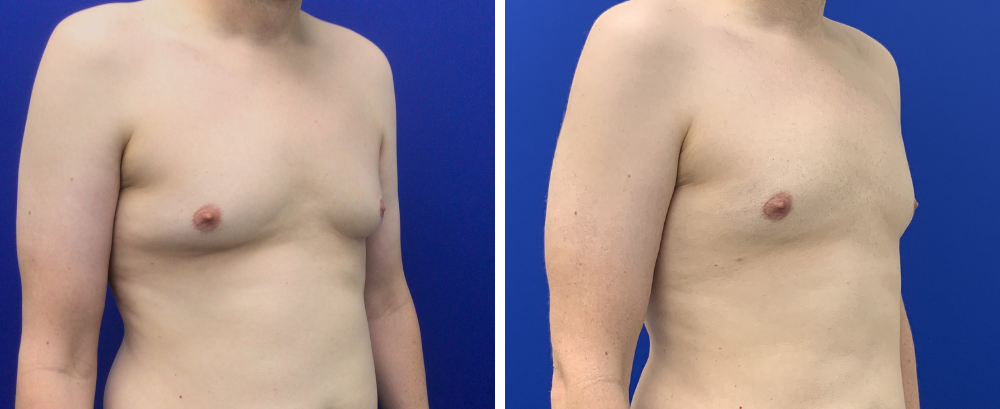 Gynecomastia Case 10-2