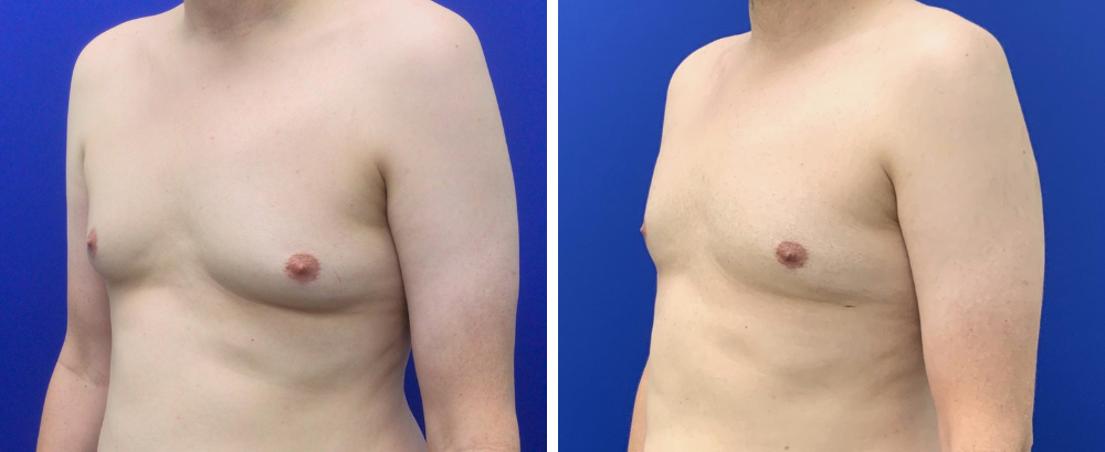 Gynecomastia Case 10-3