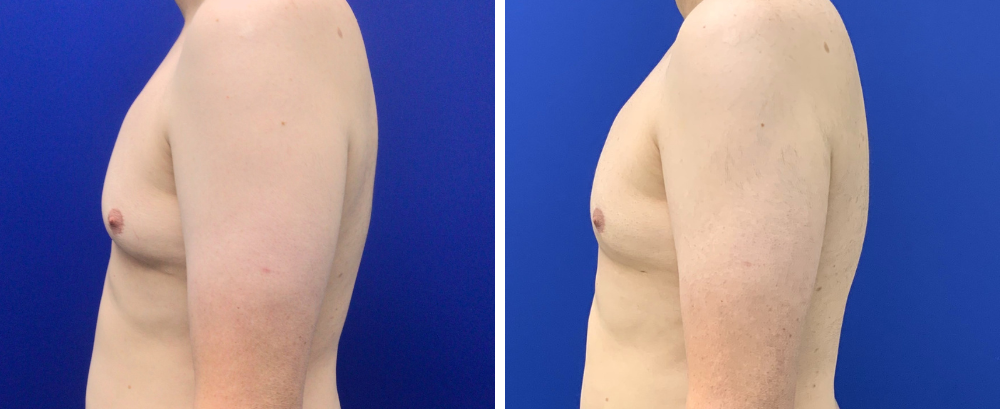 Gynecomastia Case 10-4
