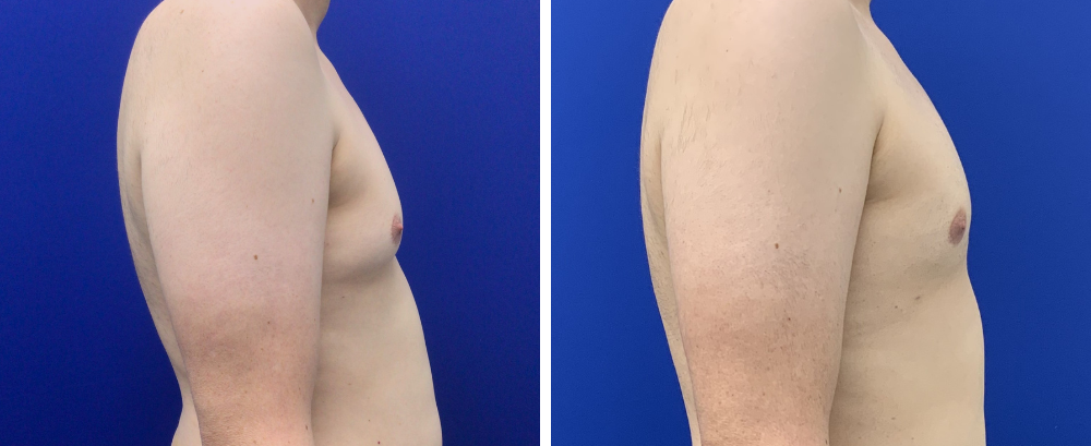 Gynecomastia Case 10-5