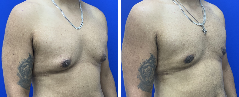 Gynecomastia Case 11-2