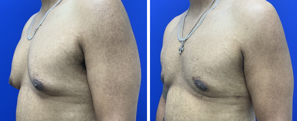 Gynecomastia Case 11-3