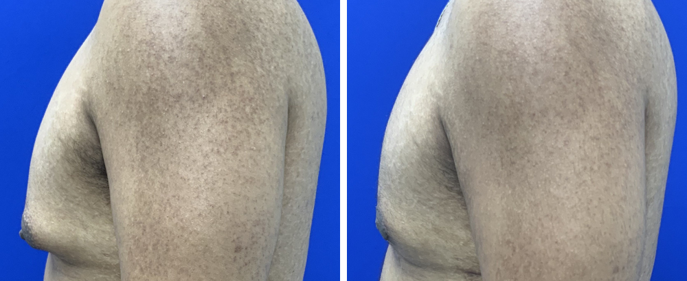 Gynecomastia Case 11-4