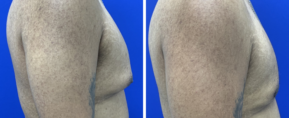 Gynecomastia Case 11-5