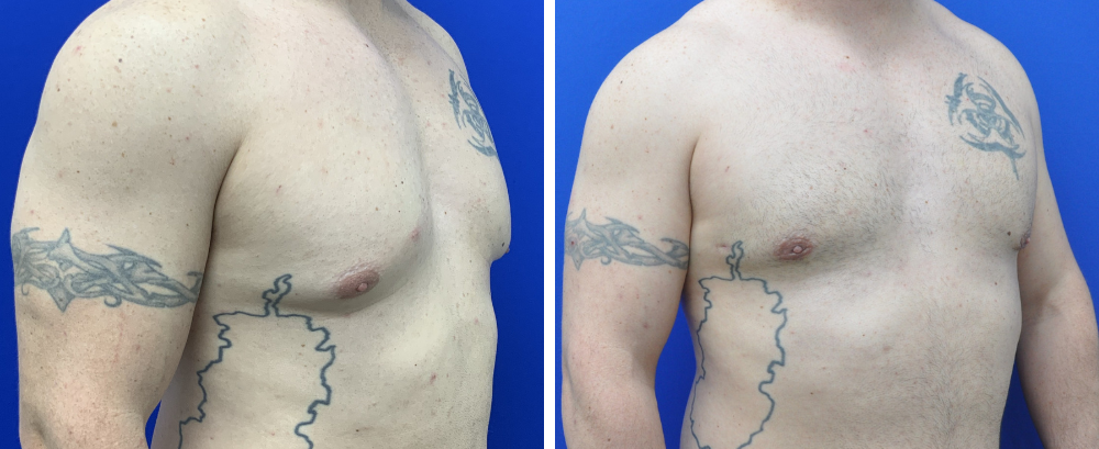 Gynecomastia Case 8-2