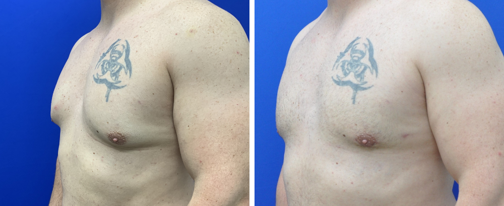 Gynecomastia Case 8-3