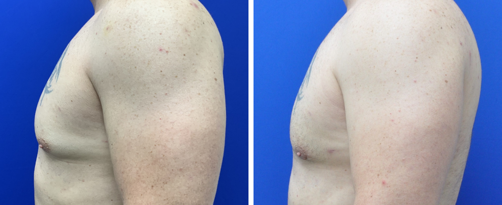 Gynecomastia Case 8-4