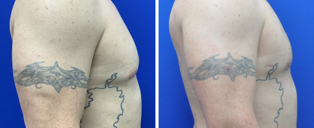Gynecomastia Case 8-5