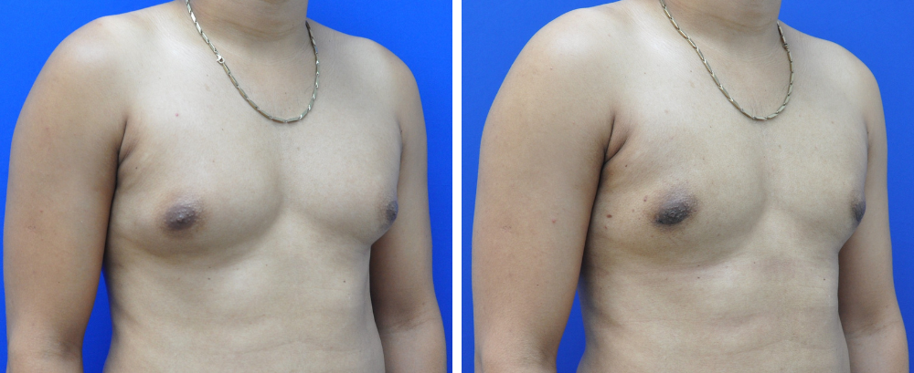 Gynecomastia Case 9-2