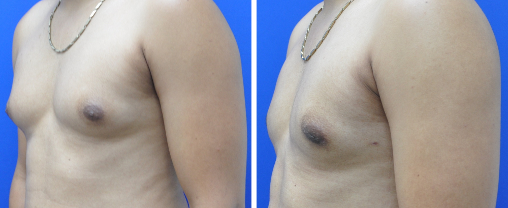 Gynecomastia Case 9-3