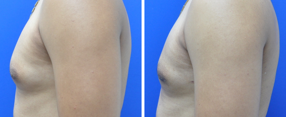 Gynecomastia Case 9-4