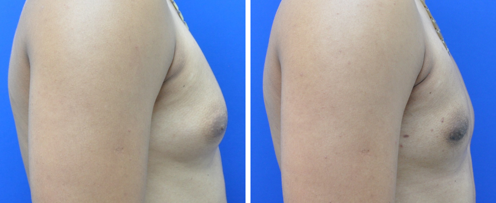 Gynecomastia Case 9-5