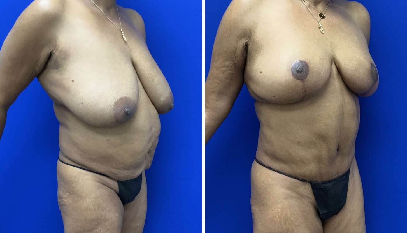 Mommy Makeover Case 7-02