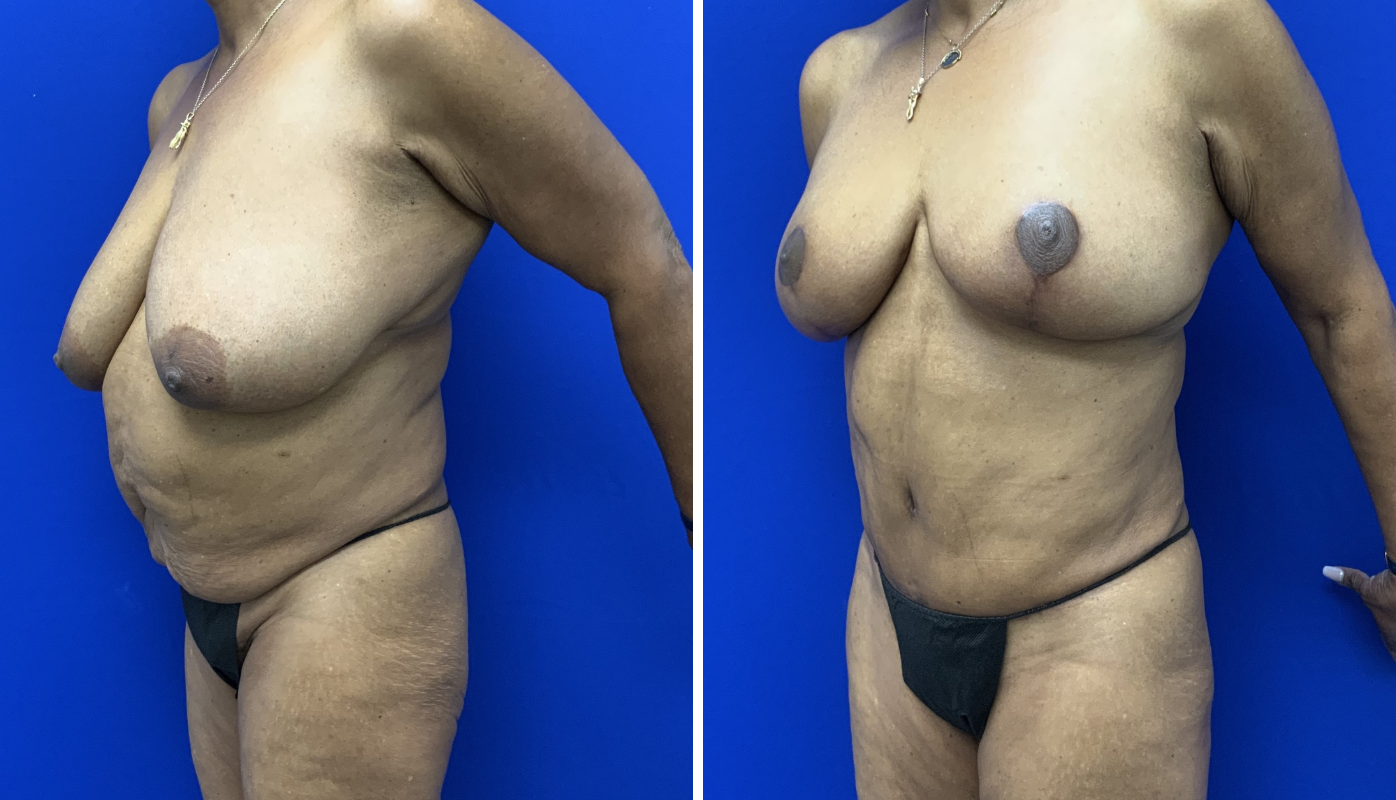 Mommy Makeover Case 7-03