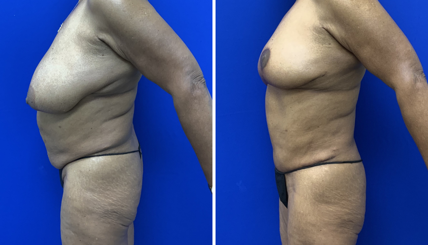 Mommy Makeover Case 7-05
