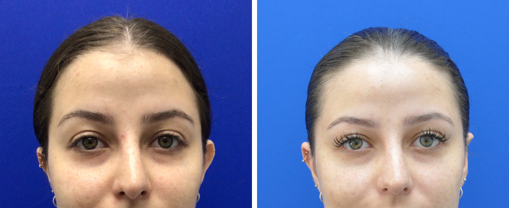Otoplasty Case 5-3