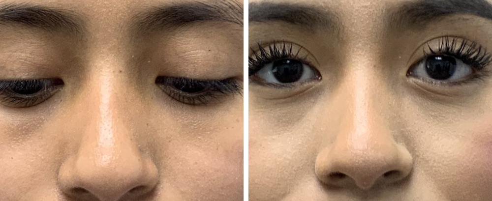 Otoplasty Case 6-1