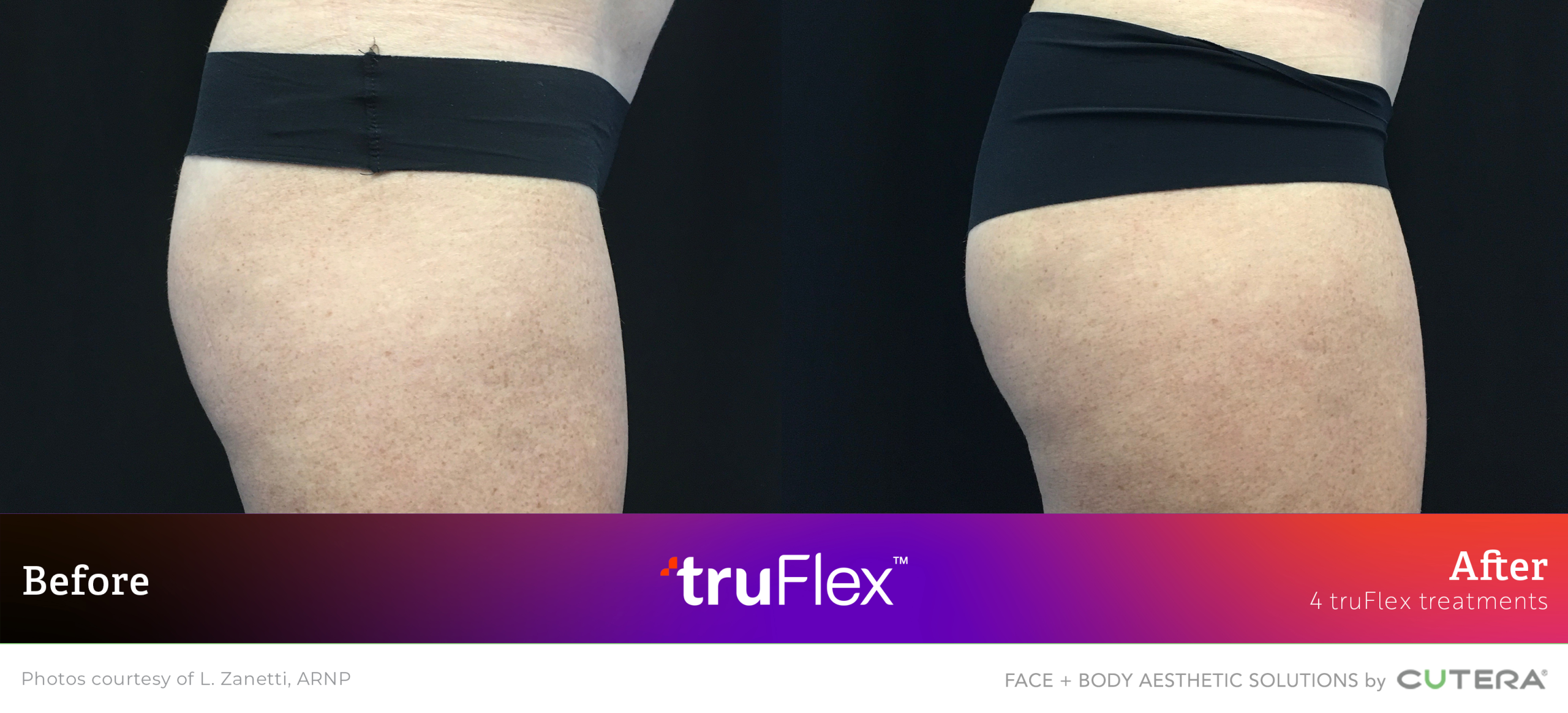 Before and after hip and buttock contouring with truSculpt flex treatment