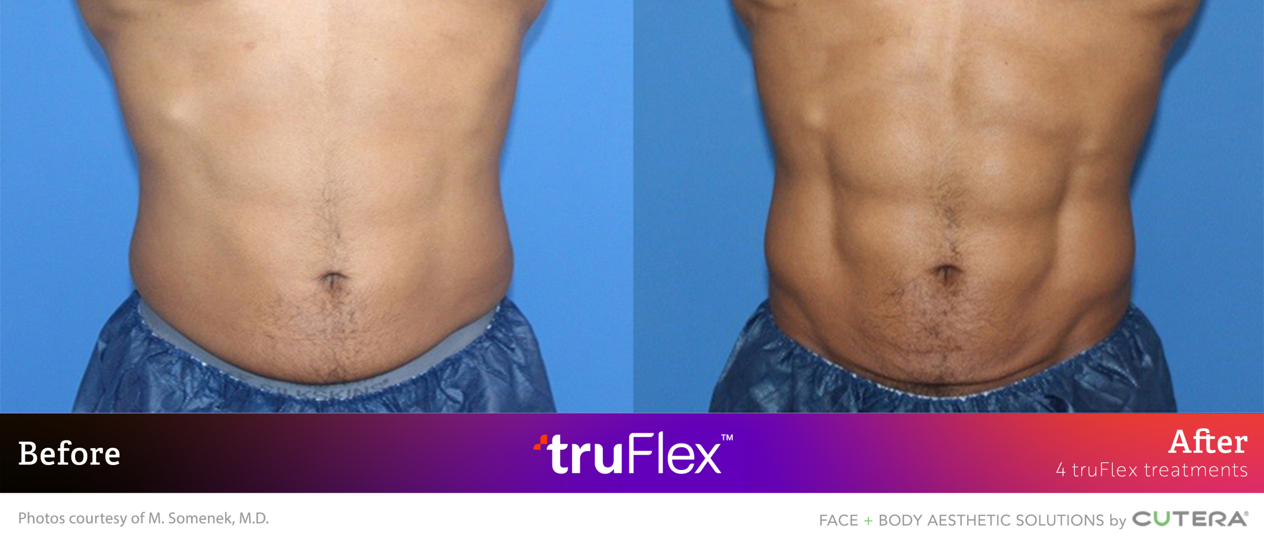 Before and after abdominal definition with truSculpt flex treatment showing enhanced muscle tone
