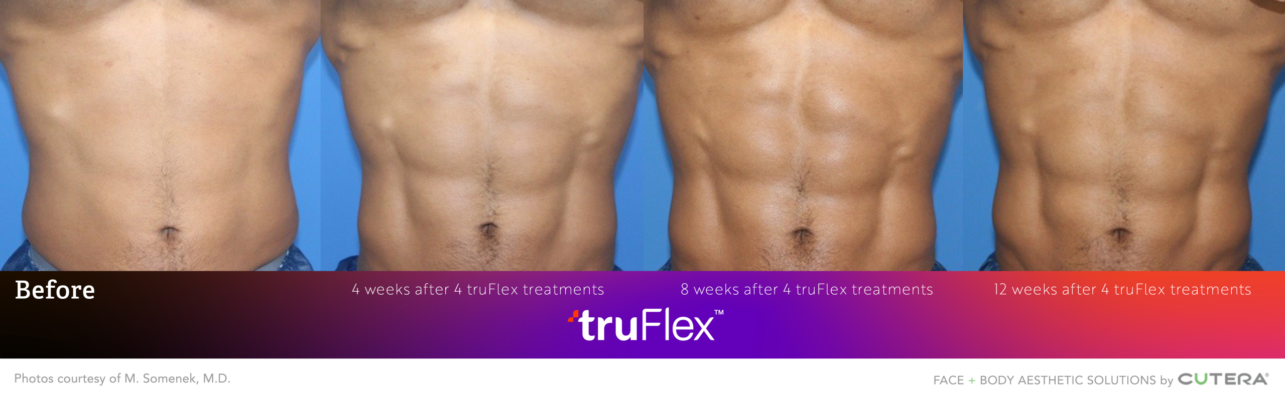 Progressive abdominal muscle definition at 4, 8, and 12 weeks following truSculpt flex treatments