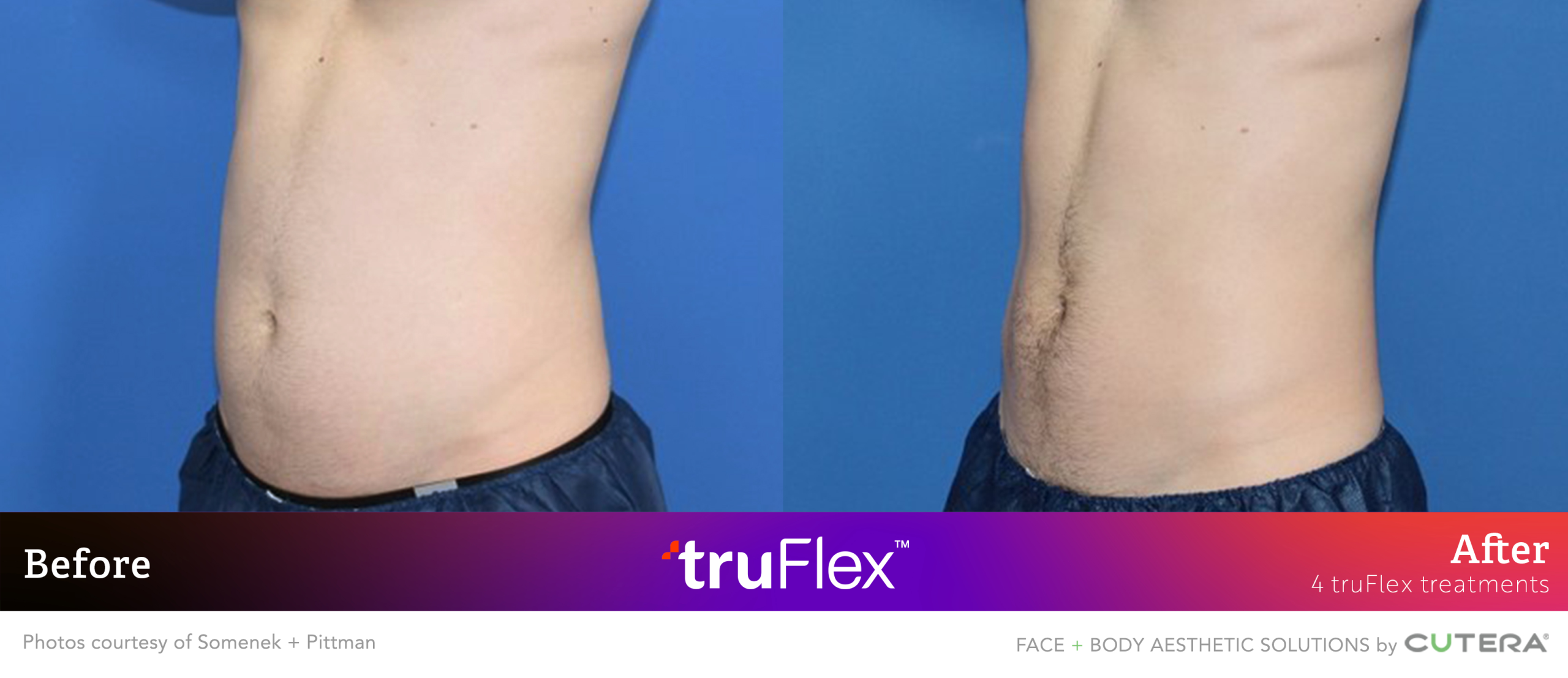 Before and after abdominal contouring with truSculpt flex treatment showing reduced midsection fullness