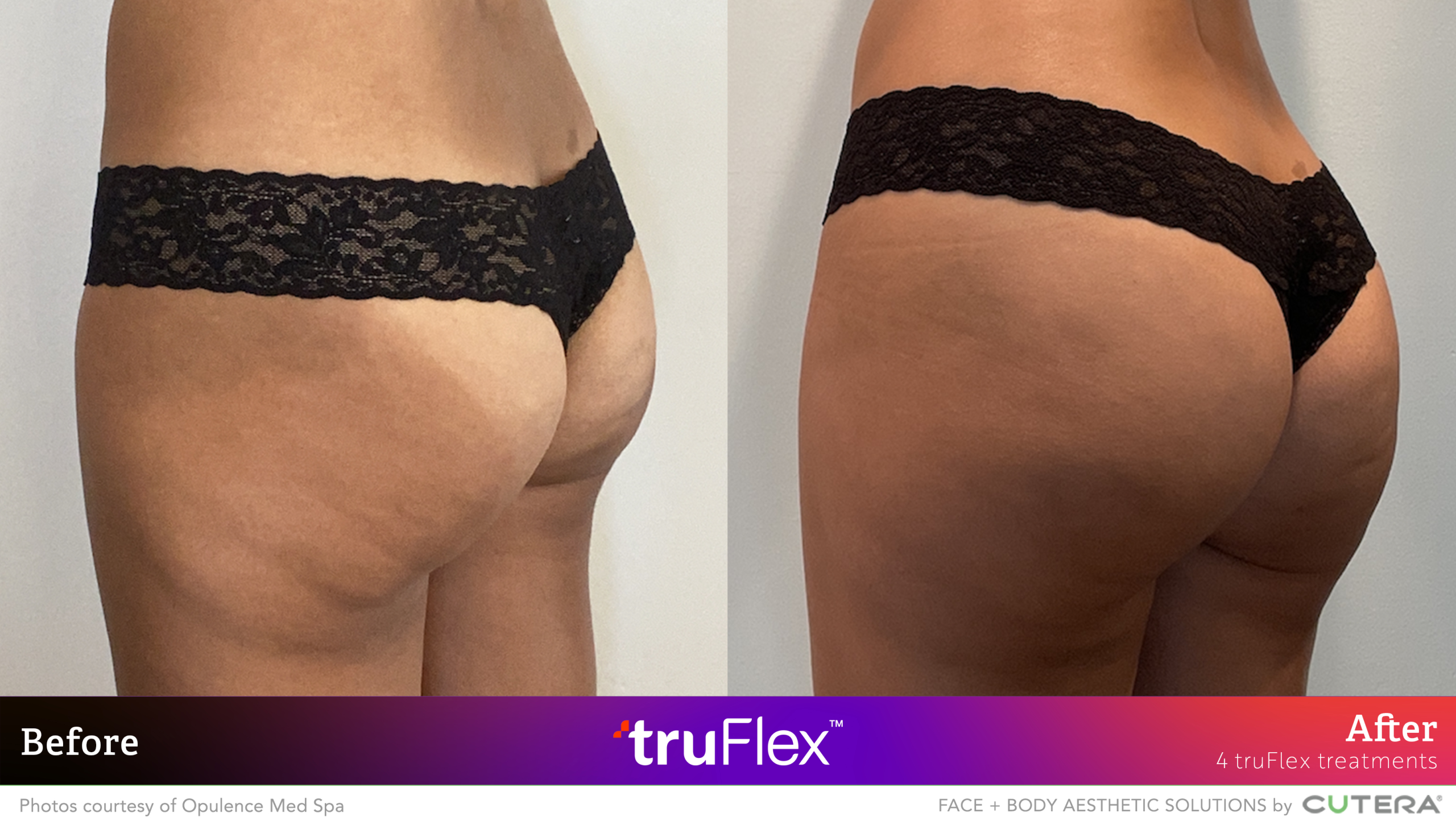 Before and after comparison of buttocks showing results after 4 truFlex treatments