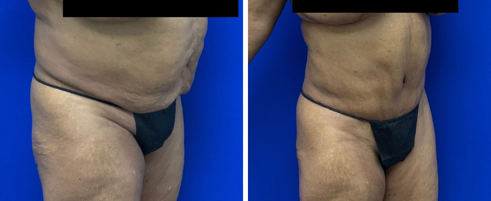 Tummy Tuck Case 21-2
