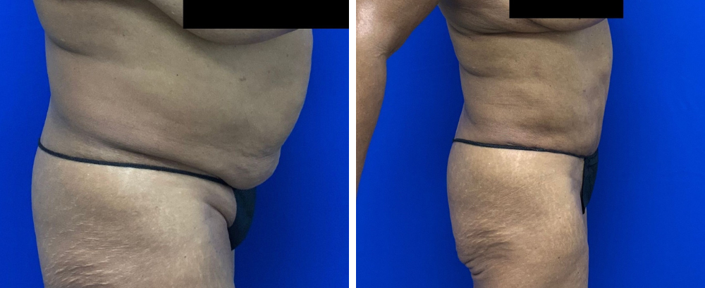 Tummy Tuck Case 21-3