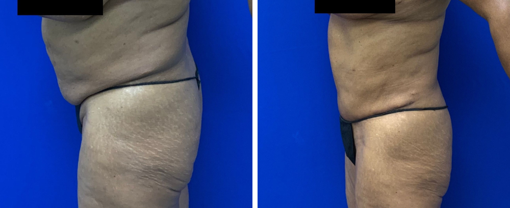 Tummy Tuck Case 21-4