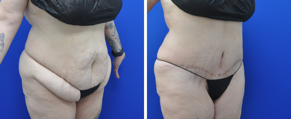 Tummy Tuck Case 22-2