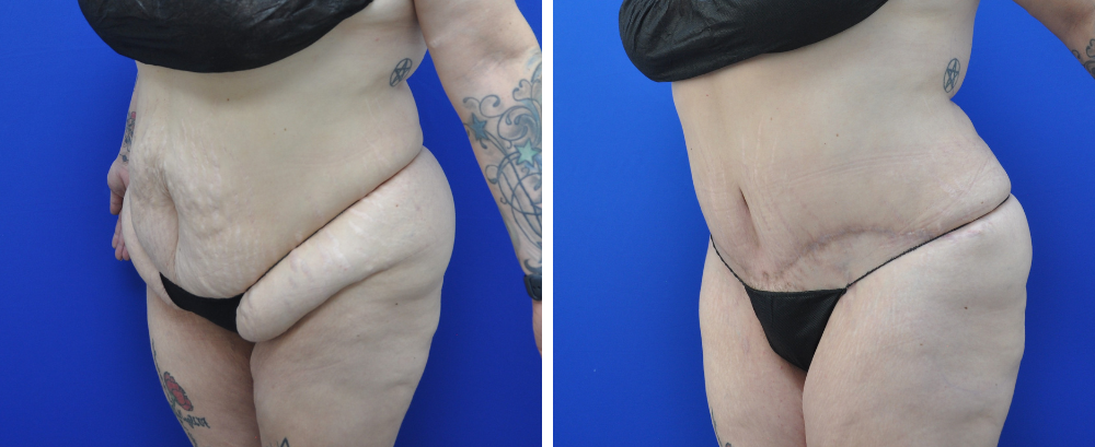 Tummy Tuck Case 22-3