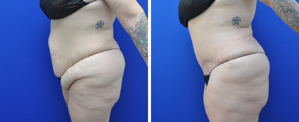 Tummy Tuck Case 22-4