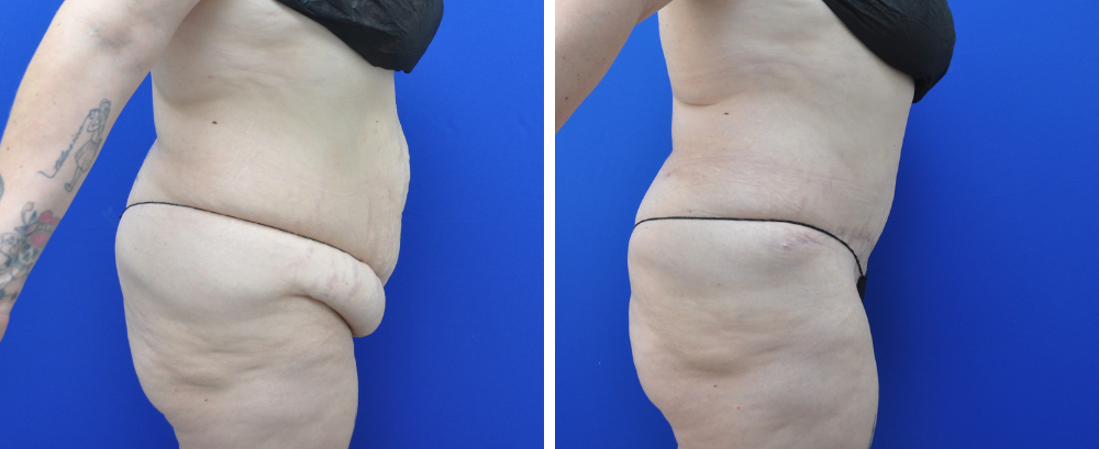 Tummy Tuck Case 22-5