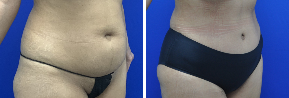 tummy tuck case 24-cropped2