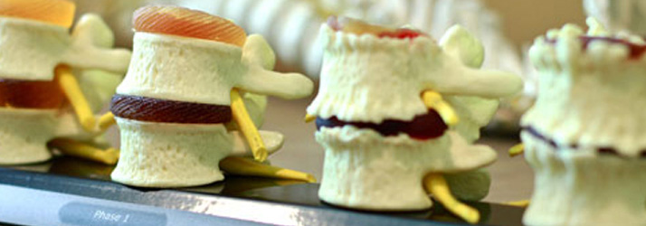 Model of spine vertebrae with herniated disc displayed
