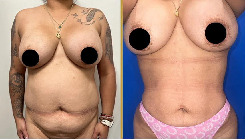 Before and after awake liposuction results showing torso and abdomen contouring