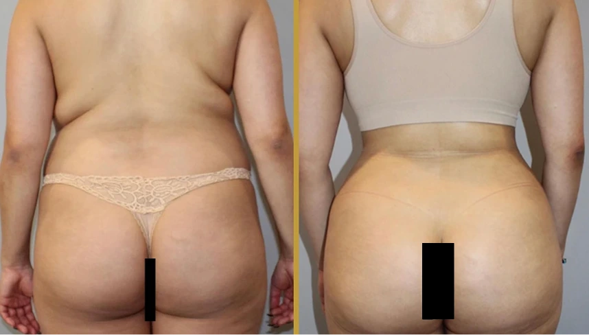 Before and after awake liposuction showing back and buttock definition improvement