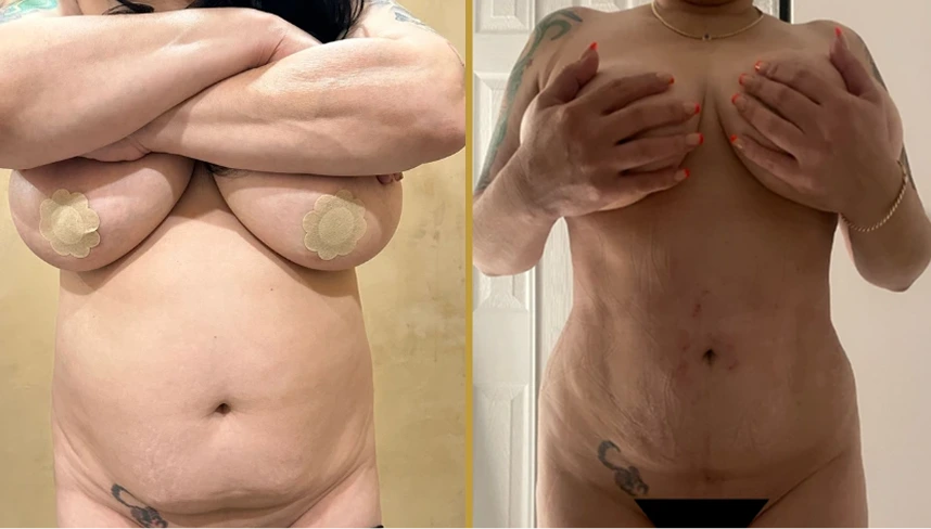 Before and after awake liposuction showing breast and abdominal body contouring