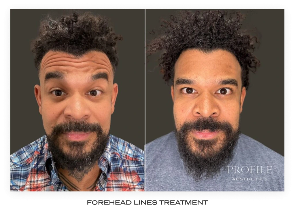 Before and after forehead lines treatment showing reduced forehead wrinkles in after photo labeled FOREHEAD LINES TREATMENT
