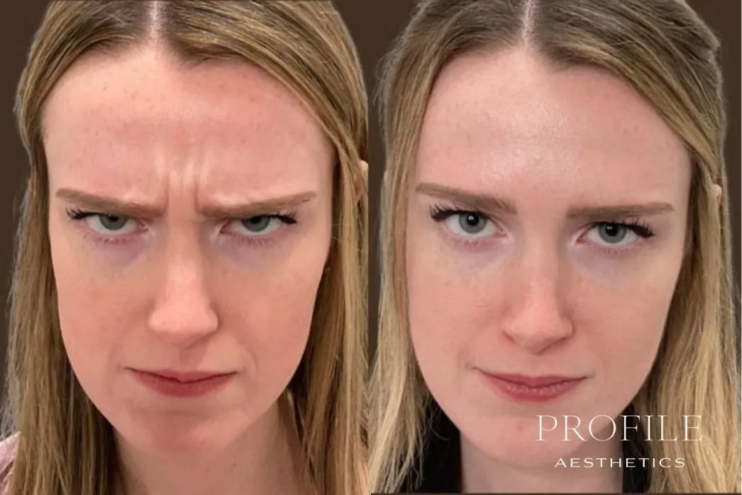Before and after downward gaze showing reduced frown lines between brows after neurotoxin treatment