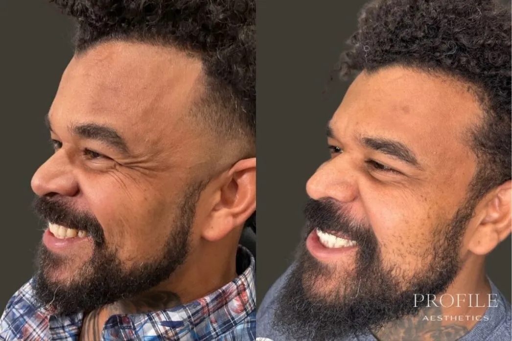 Man in profile before and after Botox treatment showing reduced forehead wrinkles