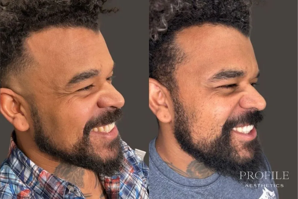 Man in profile before and after Botox treatment with smoother forehead and fewer expression lines