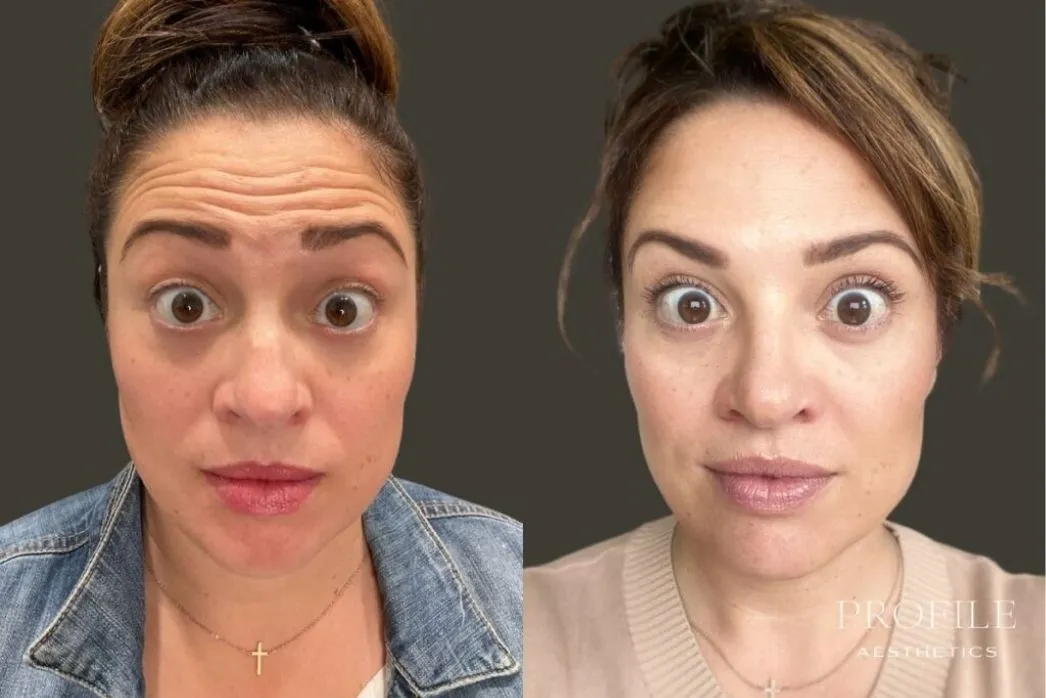 Woman facing forward before and after Botox treatment showing reduced forehead lines and expression wrinkles