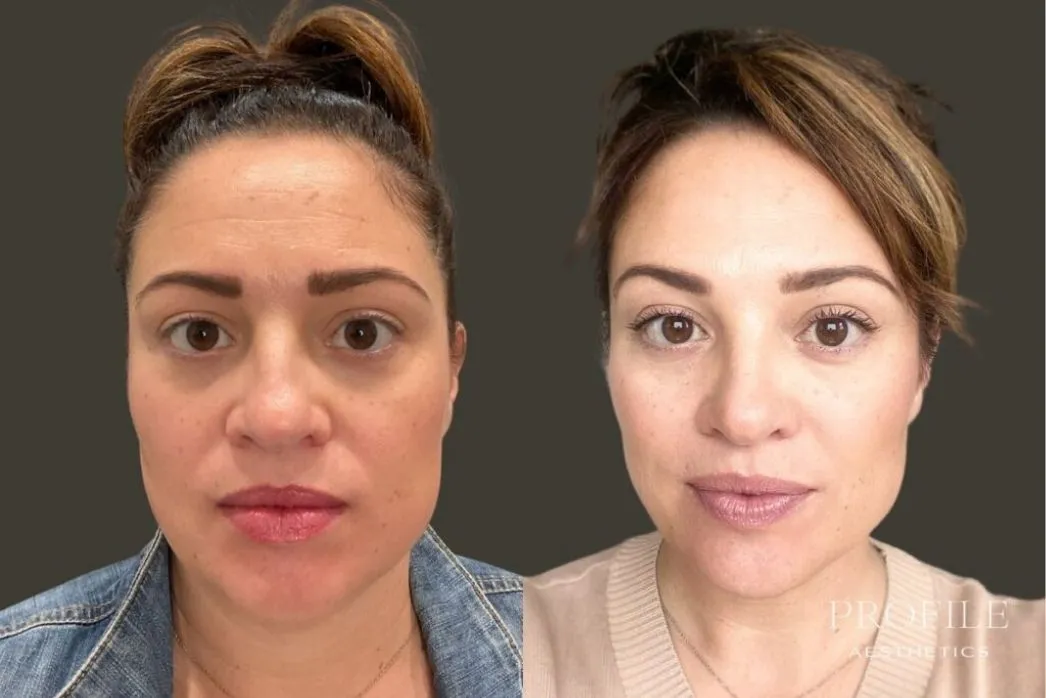 Woman facing forward before and after Botox treatment with smoothed forehead and brow area