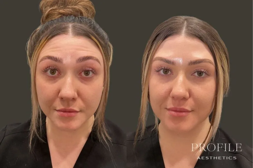 Before and after comparison of woman's face showing reduced forehead wrinkles after neurotoxin treatment