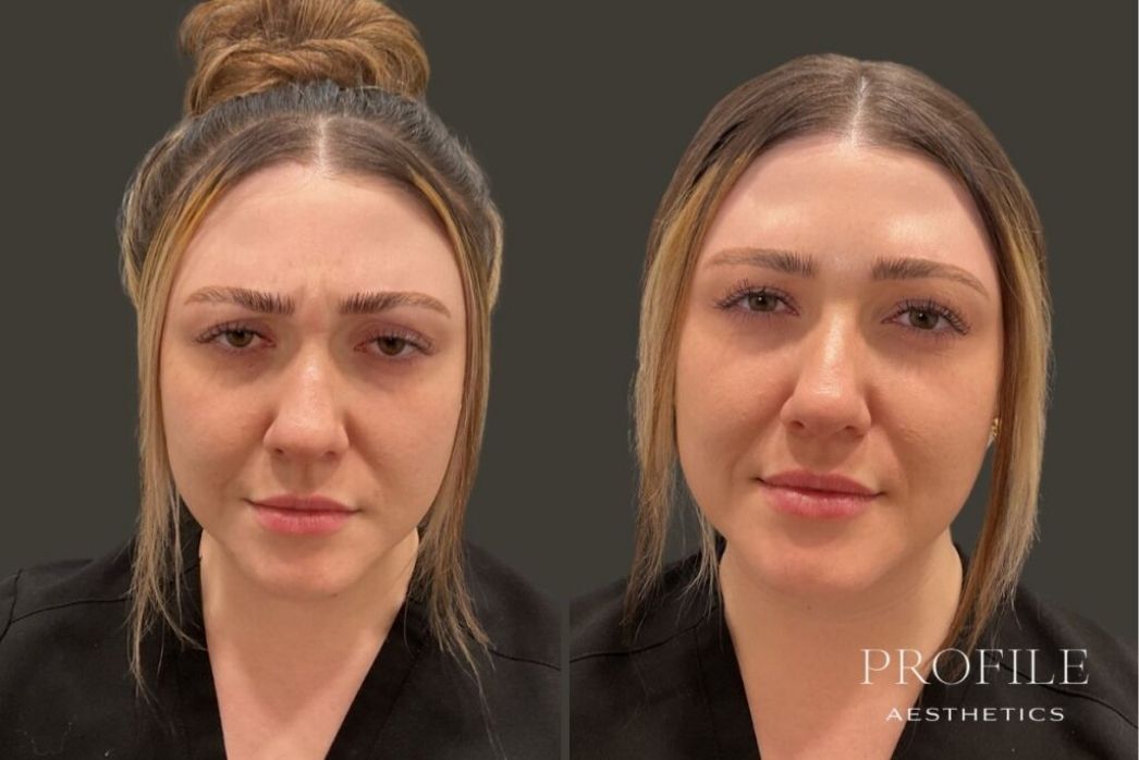 Botox and Neurotoxins (15)