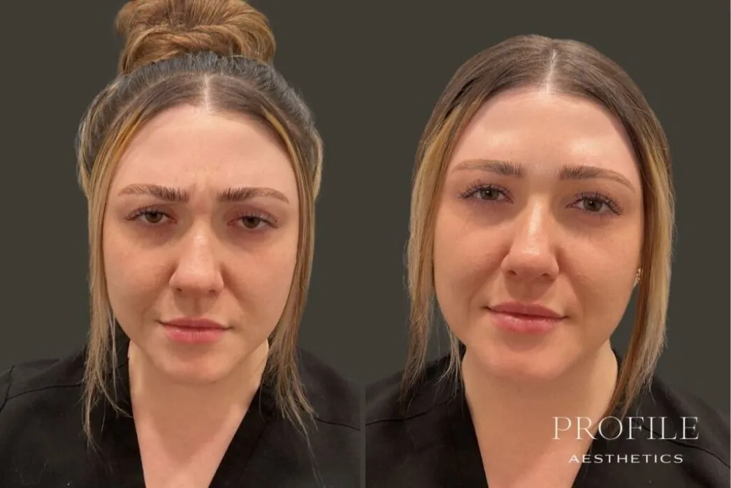 Woman facing forward before and after Botox treatment with softened forehead lines and brow elevation